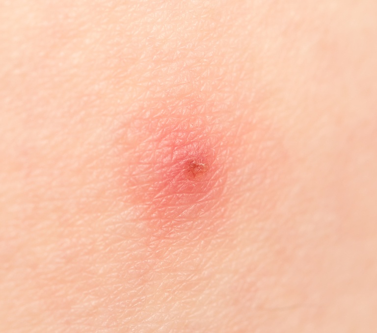 How Do You Treat An Insect Sting While Camping?