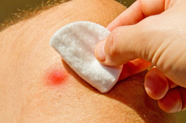 How Do You Treat An Insect Sting While Camping?