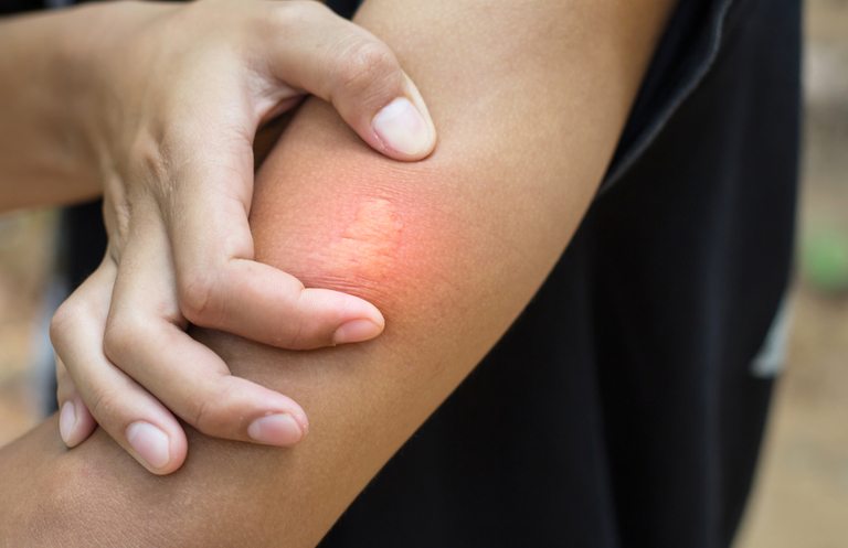 How Do You Treat An Insect Sting While Camping?