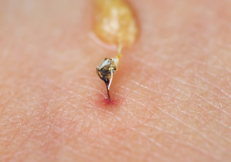 How Do You Treat An Insect Sting While Camping?
