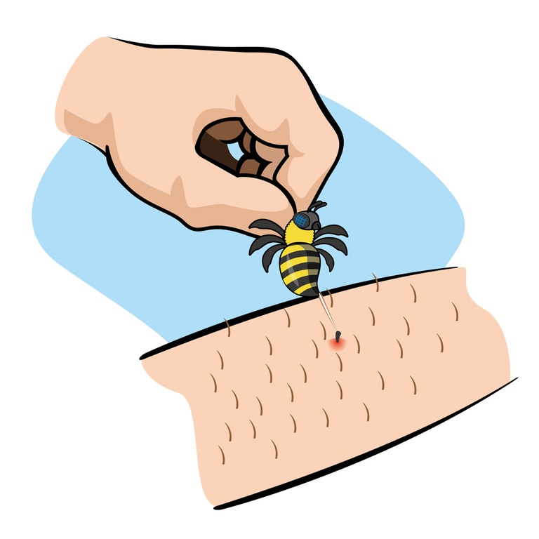 How Do You Treat An Insect Sting While Camping?