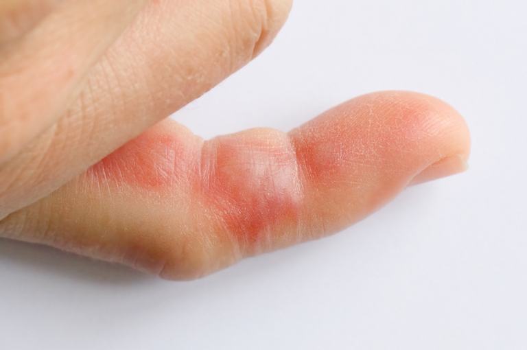 How Do You Treat An Insect Sting While Camping?