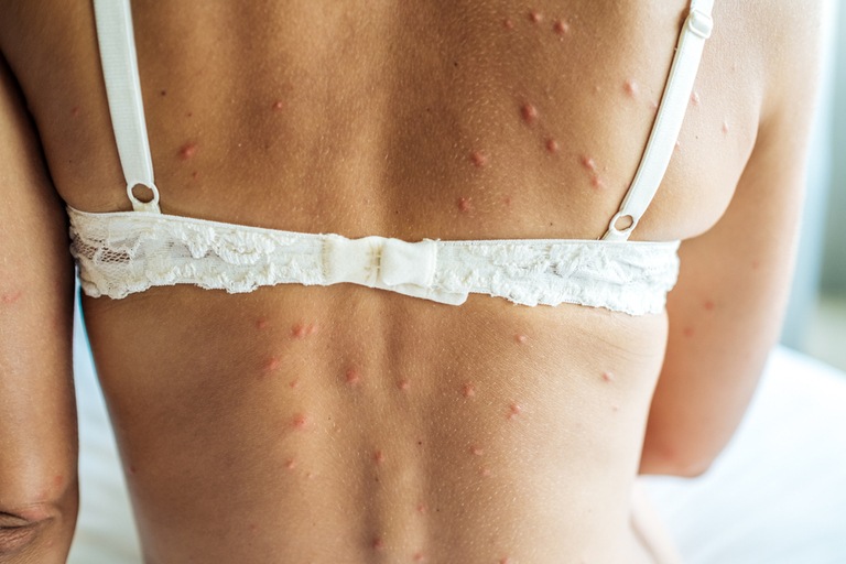 How Do You Treat An Insect Sting While Camping?