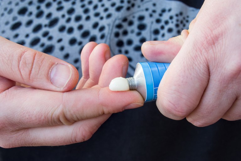 How Do You Treat An Insect Sting While Camping?