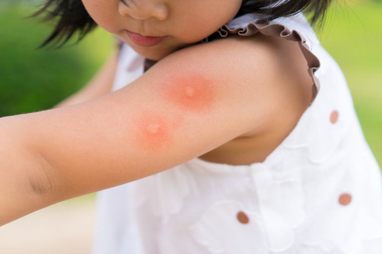 How Do You Treat An Insect Sting While Camping?