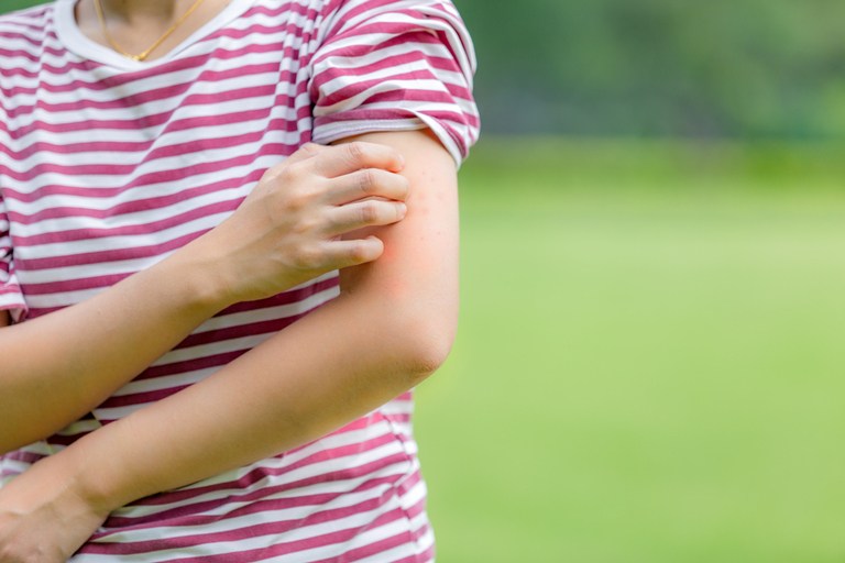 How Do You Treat An Insect Sting While Camping?